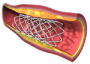 Koronární stent v cévě